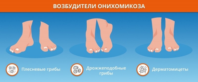 Грибковые заболевания ногтей: виды и проявления, лечение болезни и профилактика