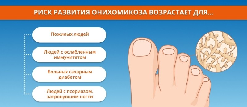 Грибок ногтей: причины и симптомы