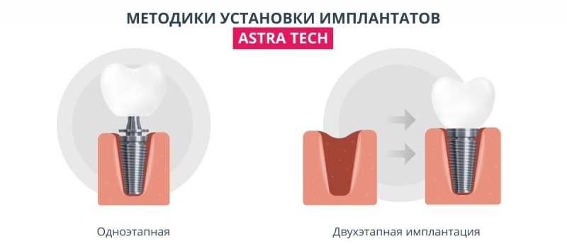 Имплантаты Astra Tech: звездные технологии