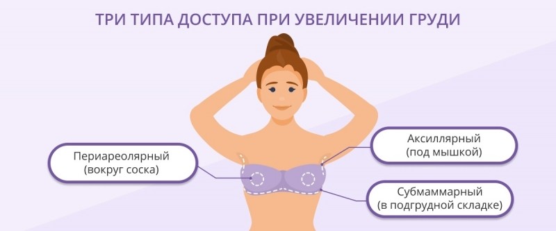 Сколько стоит увеличение груди в Санкт-Петербурге: обзор методов и цен на процедуры