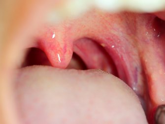 Чем можно полоскать горло при воспалении: домашние средства и препараты с аптечных полок