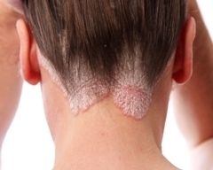 Псориаз волосистой части головы: причины, симптомы, лечение