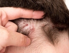 Псориаз волосистой части головы: причины, симптомы, лечение